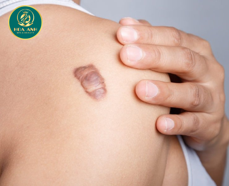 Sẹo phì đại và sẹo lồi: Điểm giống và khác nhau ?